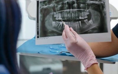 Prothèse dentaire à Tarbes : quelles options pour restaurer votre sourire