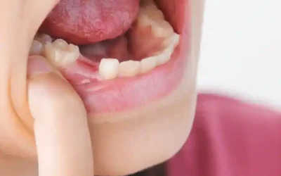 Dent définitive chez l’enfant : quand pousse-t-elle ?
