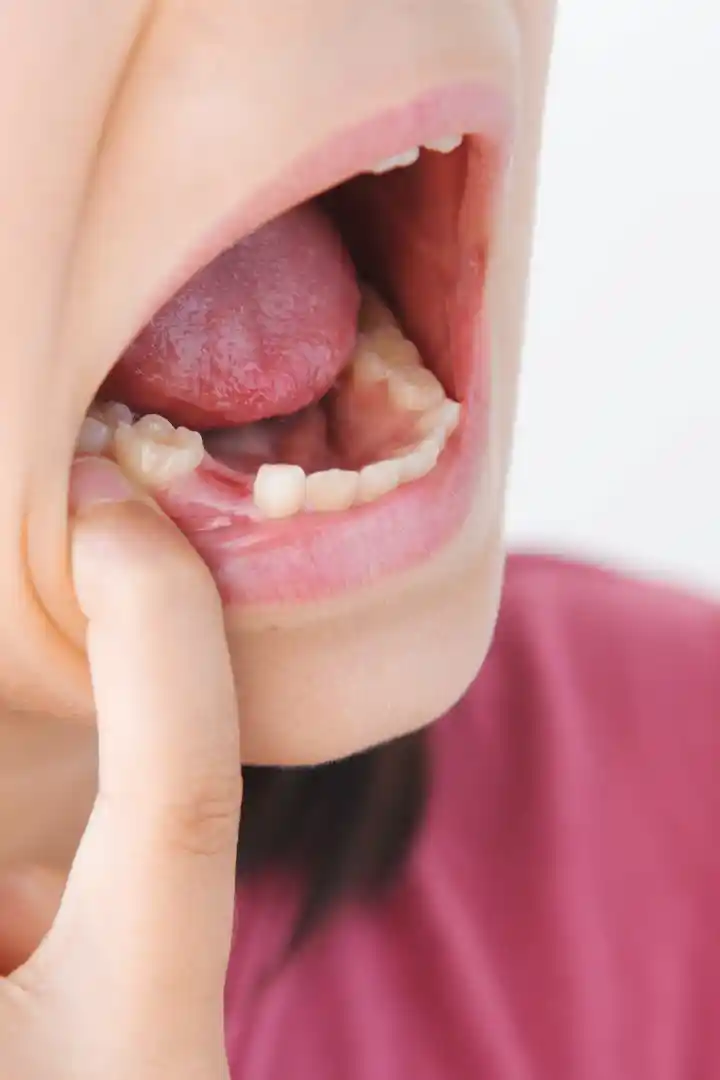 Implants dentaires à Tarbes : étapes, avantages et prise en charge – Clinique 3S