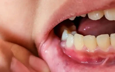 Pourquoi les gencives saignent-elles ? Causes et solutions