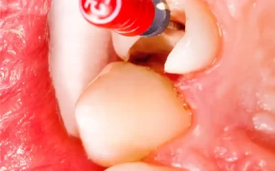 Dévitalisation dentaire : quand faut-il traiter une dent ?