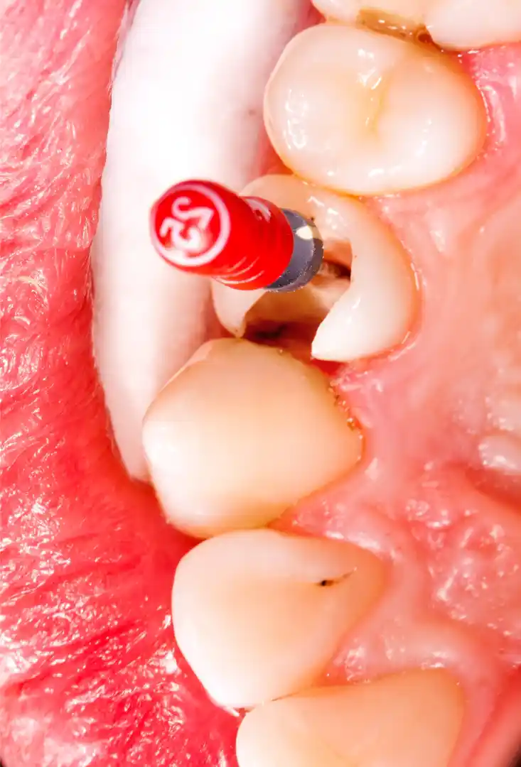 Implants dentaires à Tarbes : étapes, avantages et prise en charge – Clinique 3S